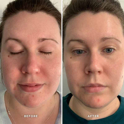 Alpha-H Vitamin A Serum with 0.5% Retinol | 4 weeks using vitamin a for face