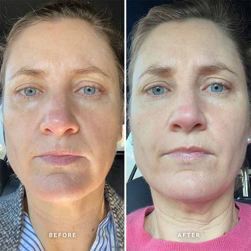 Alpha-H Vitamin A Serum with 0.5% Retinol | facial serum | 8 week before and after using vitamin a facial serum