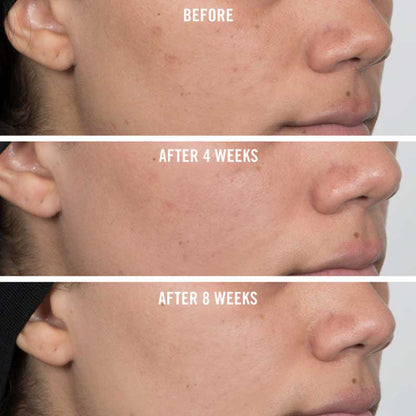 First Aid Beauty Facial Radiance Niacinamide Dark Spot Serum | Hyperpigmentation | Dark spots | Blemishes | Discolouration | Sunspots | Before and after