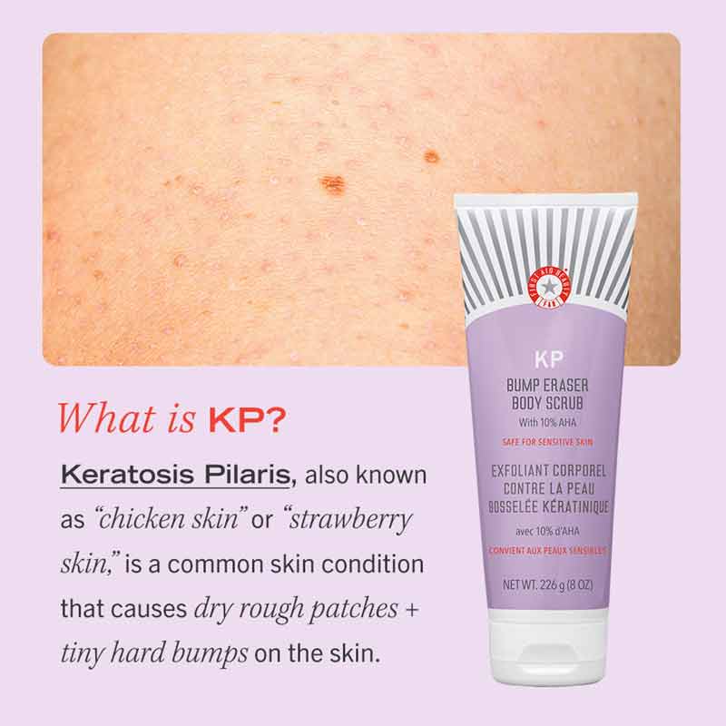 First Aid Beauty KP Bump Eraser Body Scrub with 10% AHA