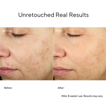 Murad InvisiScar Before & After | Spot & Blemish Scar Treatment