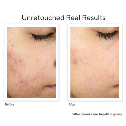 Murad InvisiScar Recovery Treatment | Acne Scar Treatment