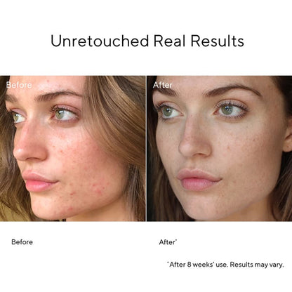 Murad InvisiScar Before & After | Spot & Blemish Scar Treatment